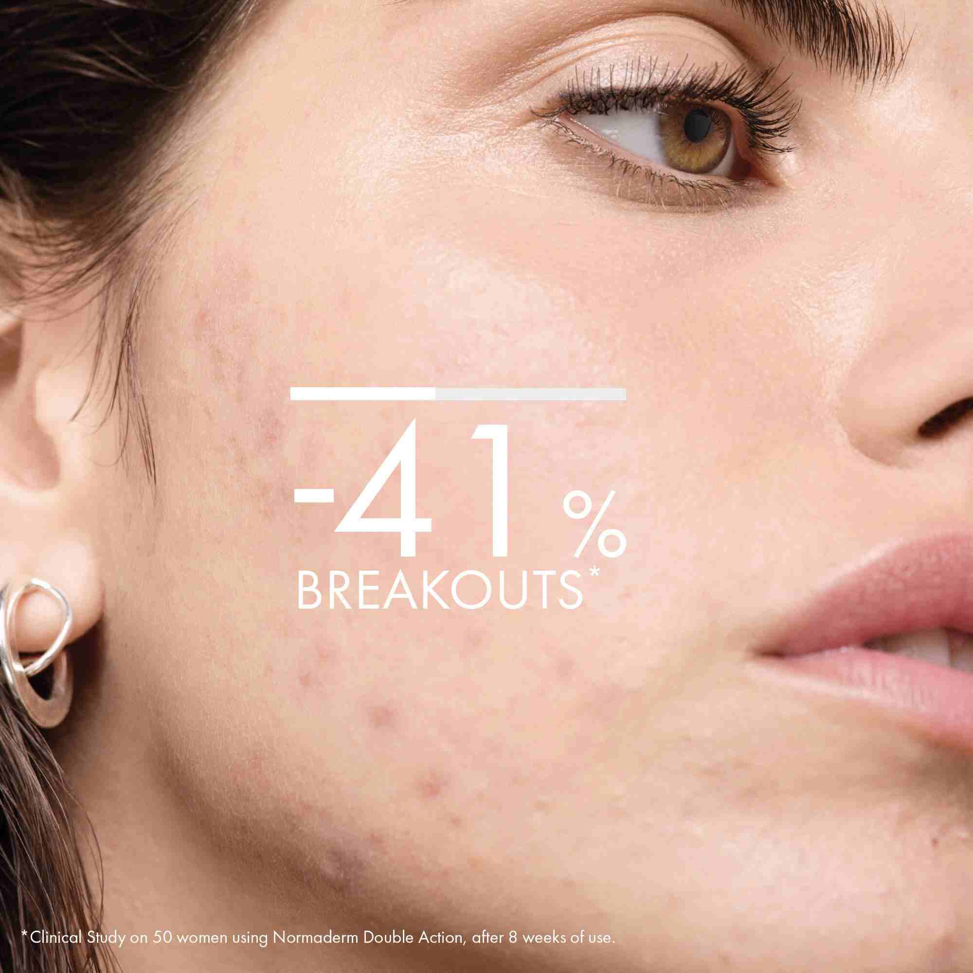 Normaderm Anti-Acne Double-Action Lotion