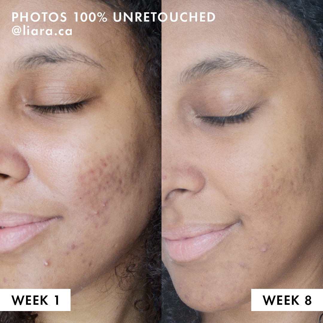 Best Salicylic Acid Gentle Acne Treatment 2021 Vichy Canada